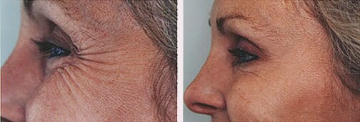 crows feet 1.jpg (38452 bytes)