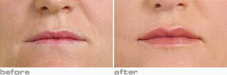 juvederm