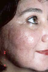 acne3-after.jpg (12599 bytes)