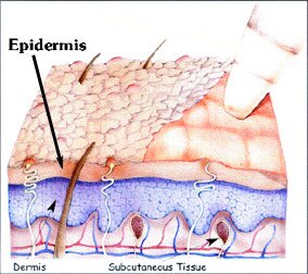 Microdermabrasion cartoon.jpg (65161 bytes)