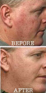 rosacea-man.jpg (23909 bytes)