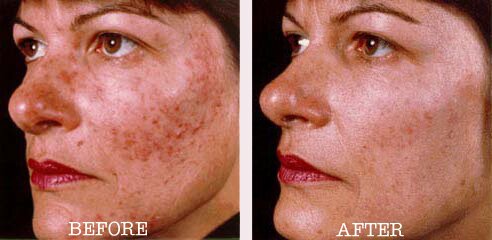 rosacea-woman.jpg (47151 bytes)