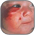 Birthmarks/Pigmented