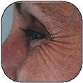 Botox Injections
