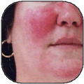 Rosacea Treatment