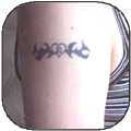 Tattoo Removal 