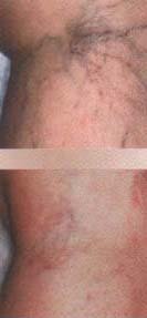 varicose bigger spider vein removal