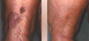 varicose blotches spider vein removal