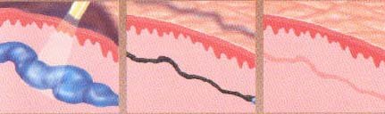 varicose spider vein removal