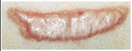 scar - before.jpg (10552 bytes)