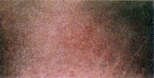 stretchmark-after.jpg (2262 bytes)