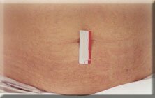 stretchmark3-abdomen-after.jpg (5675 bytes)