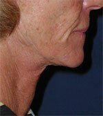 Titan Chin After Picture