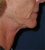 Titan Chin Before Picture
